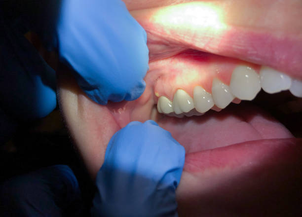 Best Emergency Dental Care for Broken or Chipped Teeth in Wapello, IA