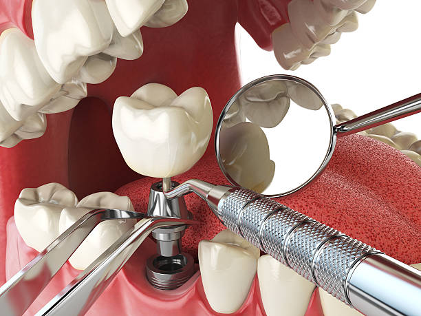 Best Emergency Tooth Extraction in Wapello, IA